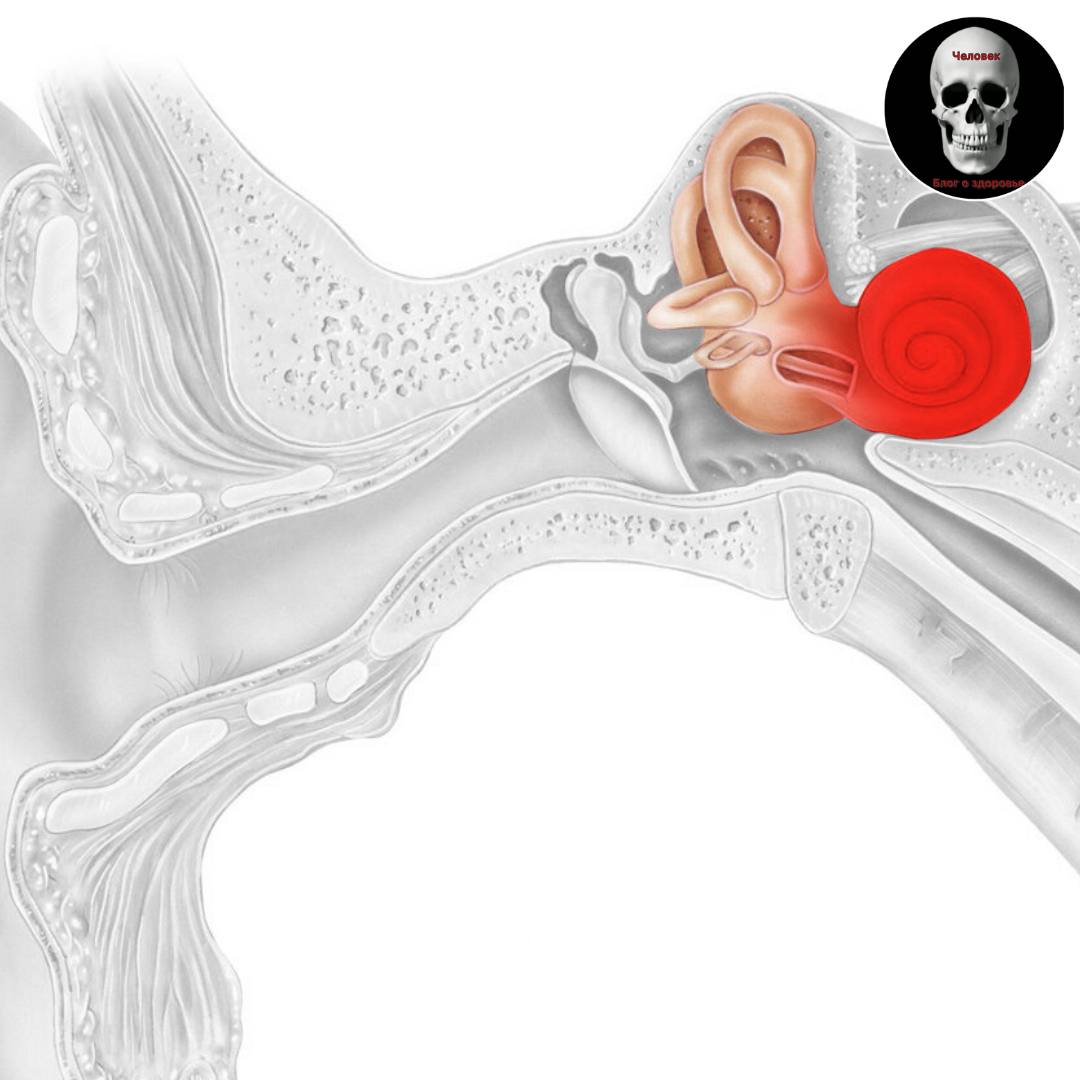 Болезнь меньера. Воспалительные заболевания внутреннего уха (лабиринтиты). Воспаление внутреннего уха лабиринтит. Лабиринтит классификация. Тимпаногенный лабиринтит.