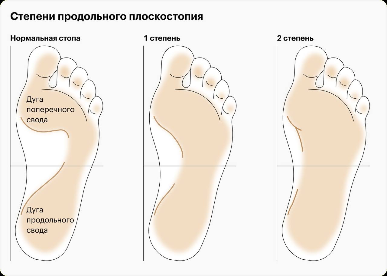 Плоскостопие 1 2 3 степени. Продольное и поперечное плоскостопие степени. 1 стадия плоскостопия. Продольное и поперечное плоскостопие степени. Степени плоскостопия 3 степени.